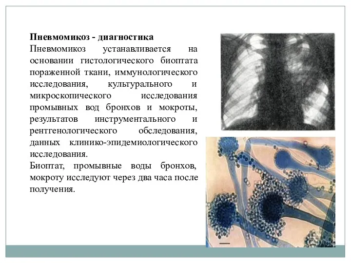 Пневмомикоз - диагностика Пневмомикоз устанавливается на основании гистологического биоптата пораженной