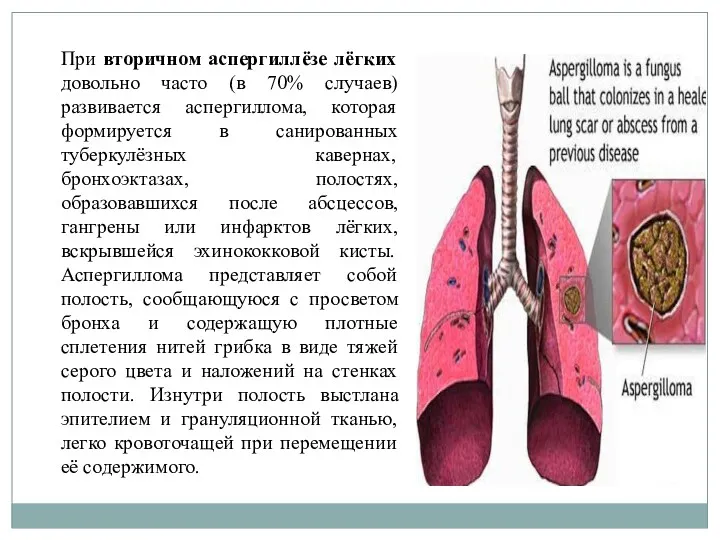 При вторичном аспергиллёзе лёгких довольно часто (в 70% случаев) развивается