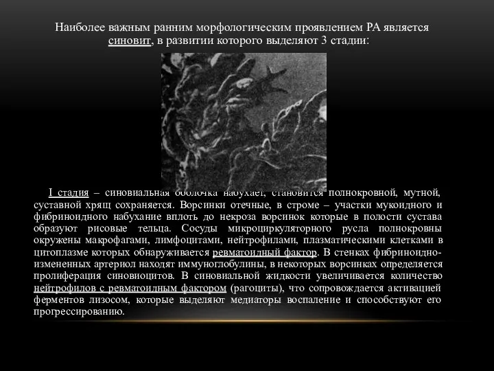 Наиболее важным ранним морфологическим проявлением РА является синовит, в развитии