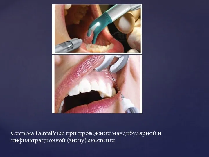 Система DentalVibe при проведении мандибулярной и инфильтрационной (внизу) анестезии