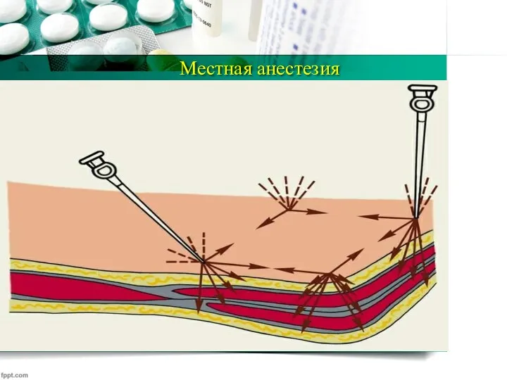 Местная анестезия