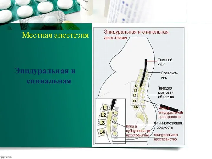 Местная анестезия Эпидуральная и спинальная