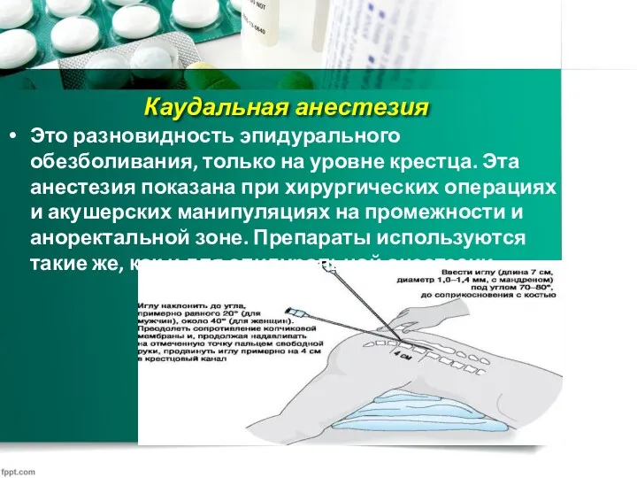 Каудальная анестезия Это разновидность эпидурального обезболивания, только на уровне крестца.