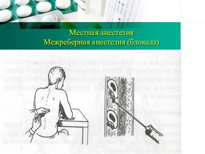 Местная анестезия Межреберная анестезия (блокада)