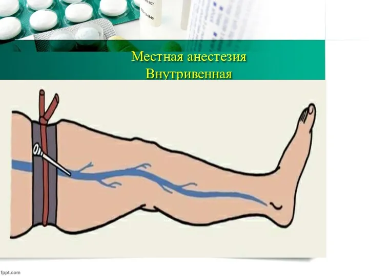 Местная анестезия Внутривенная