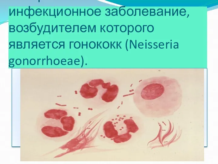 Гонорея – это контагиозное инфекционное заболевание, возбудителем которого является гонококк (Neisseria gonorrhoeae).