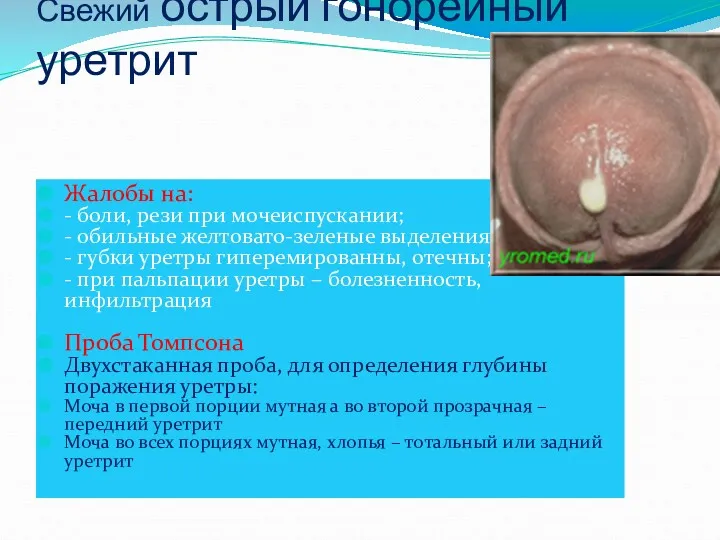 Свежий острый гонорейный уретрит Жалобы на: - боли, рези при