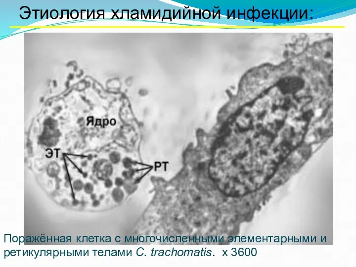 Этиология хламидийной инфекции: Поражённая клетка с многочисленными элементарными и ретикулярными телами C. trachomatis. х 3600