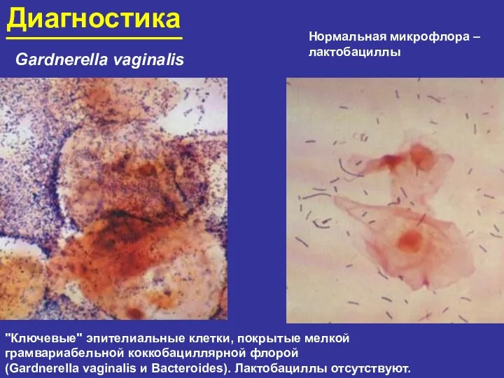 Диагностика Gardnerella vaginalis "Ключевые" эпителиальные клетки, покрытые мелкой грамвариабельной коккобациллярной