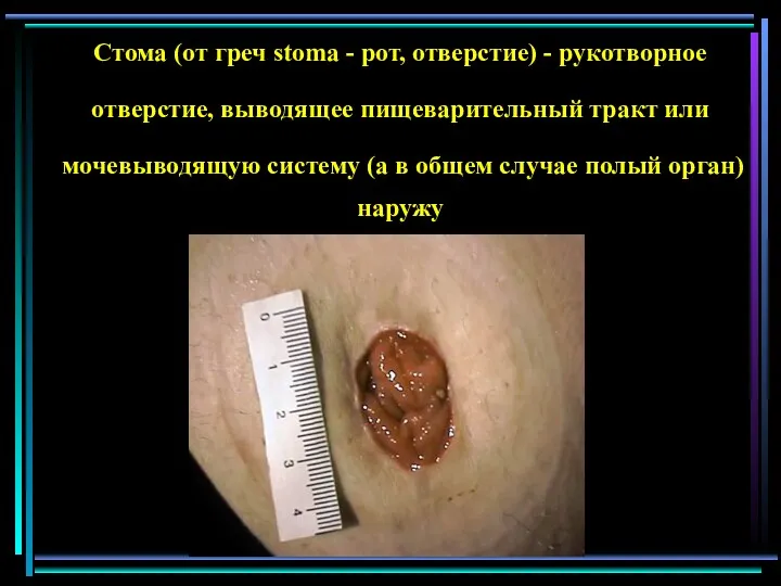 Стома (от греч stoma - рот, отверстие) - рукотворное отверстие,