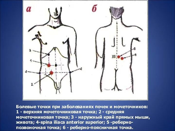 Болевые точки при заболеваниях почек и мочеточников: 1 - верхняя