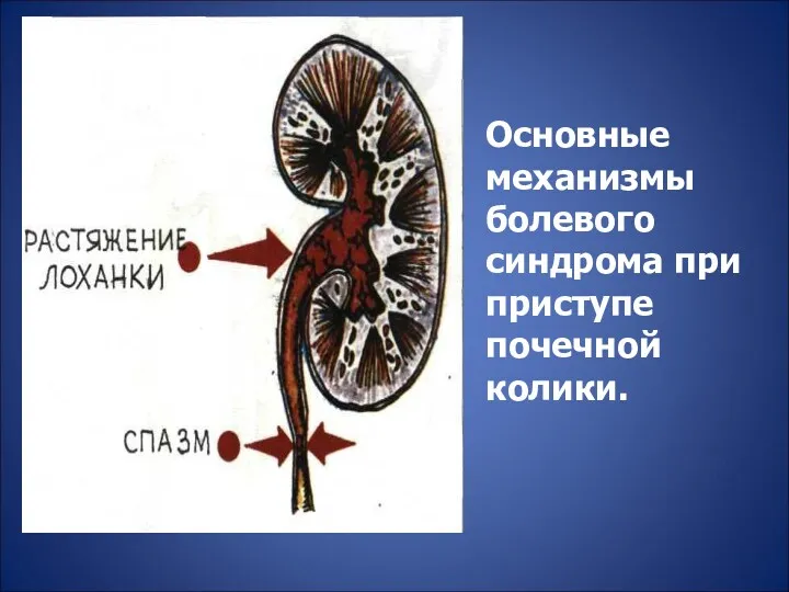 Основные механизмы болевого синдрома при приступе почечной колики.