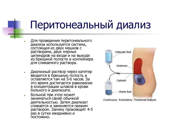 Перитонеальный диализ Для проведения перитонеального диализа используется система, состоящая из