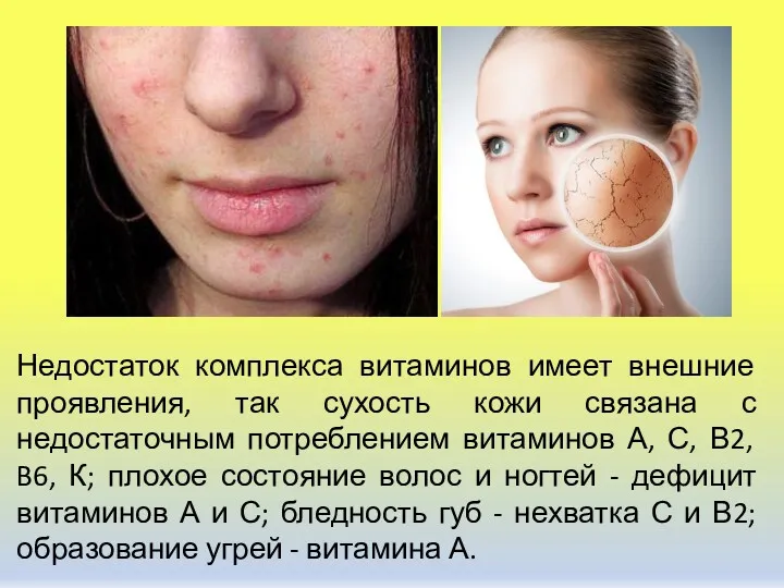 Недостаток комплекса витаминов имеет внешние проявления, так сухость кожи связана