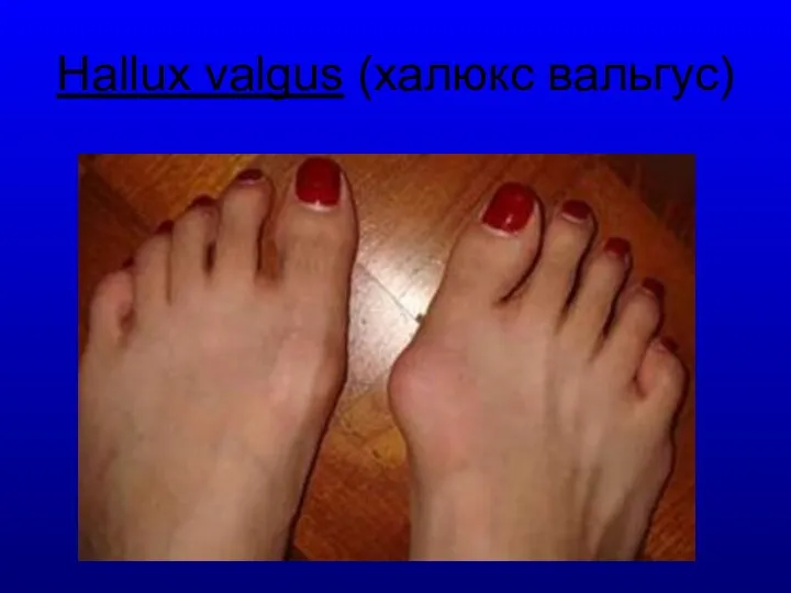 Hallux valgus (халюкс вальгус)