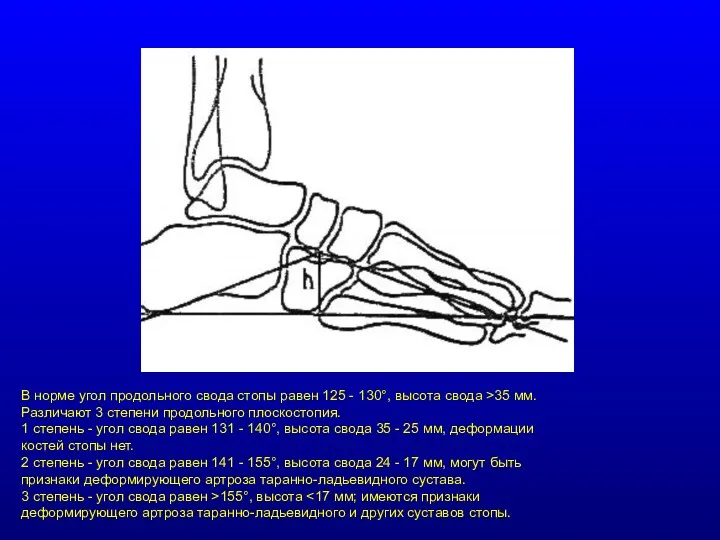 В норме угол продольного свода стопы равен 125 - 130°,