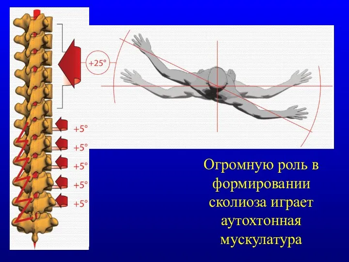 Огромную роль в формировании сколиоза играет аутохтонная мускулатура