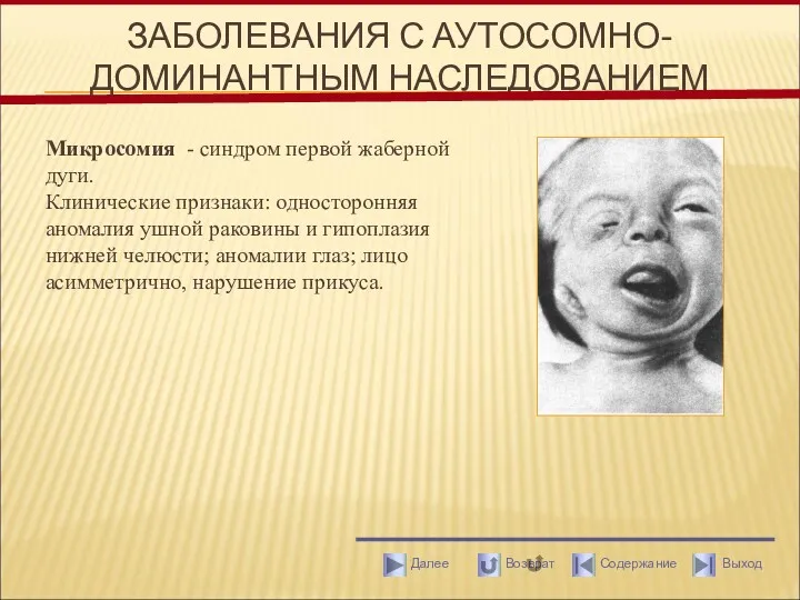 ЗАБОЛЕВАНИЯ С АУТОСОМНО-ДОМИНАНТНЫМ НАСЛЕДОВАНИЕМ Микросомия - синдром первой жаберной дуги.