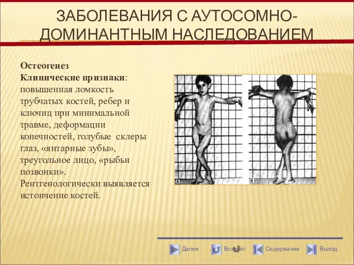 ЗАБОЛЕВАНИЯ С АУТОСОМНО-ДОМИНАНТНЫМ НАСЛЕДОВАНИЕМ Остеогенез Клинические признаки: повышенная ломкость трубчатых