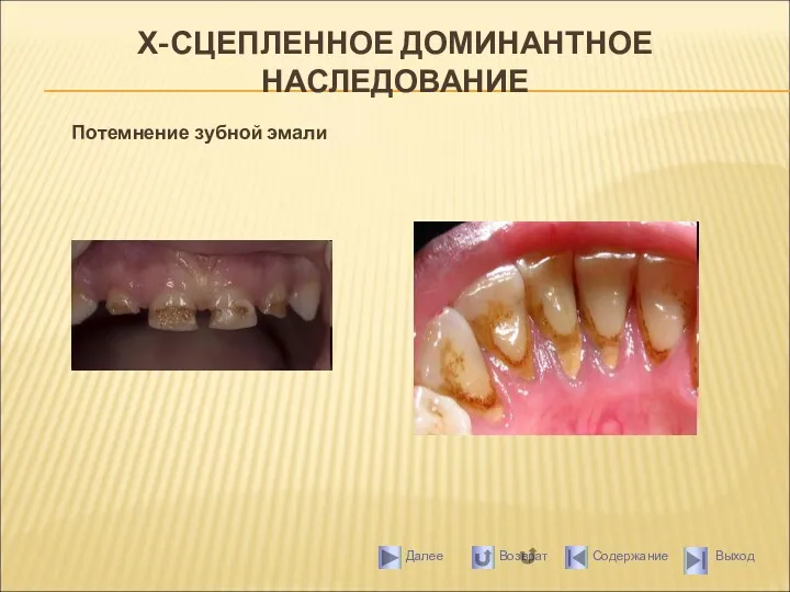 Х-СЦЕПЛЕННОЕ ДОМИНАНТНОЕ НАСЛЕДОВАНИЕ Потемнение зубной эмали
