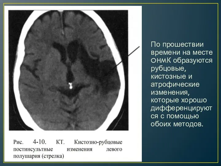 По прошествии времени на месте OHMК образуются рубцовые, кистозные и