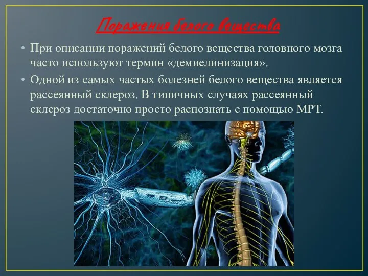 Поражения белого вещества При описании поражений белого вещества головного мозга