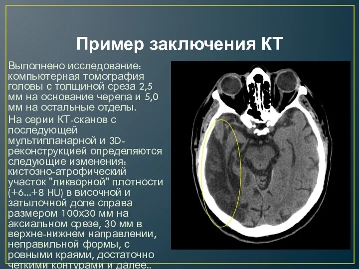 Пример заключения КТ Выполнено исследование: компьютерная томография головы с толщиной