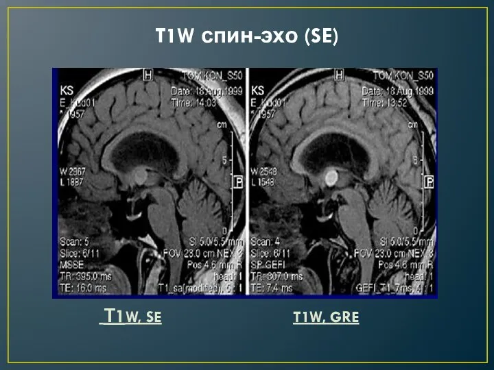 T1W спин-эхо (SE) Т1W, SE T1W, GRE