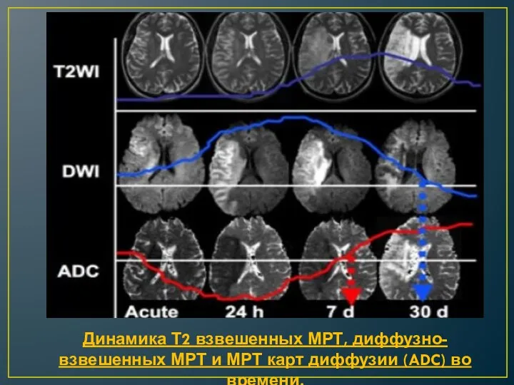 Динамика Т2 взвешенных МРТ, диффузно-взвешенных МРТ и МРТ карт диффузии (ADC) во времени.