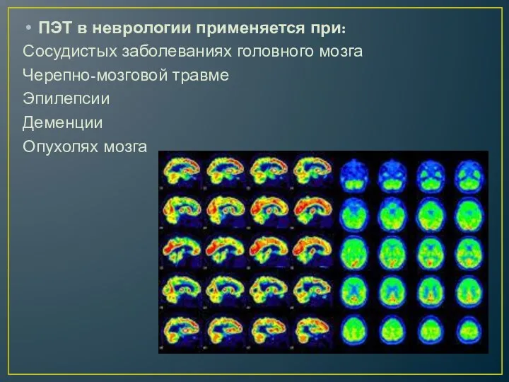 ПЭТ в неврологии применяется при: Сосудистых заболеваниях головного мозга Черепно-мозговой травме Эпилепсии Деменции Опухолях мозга