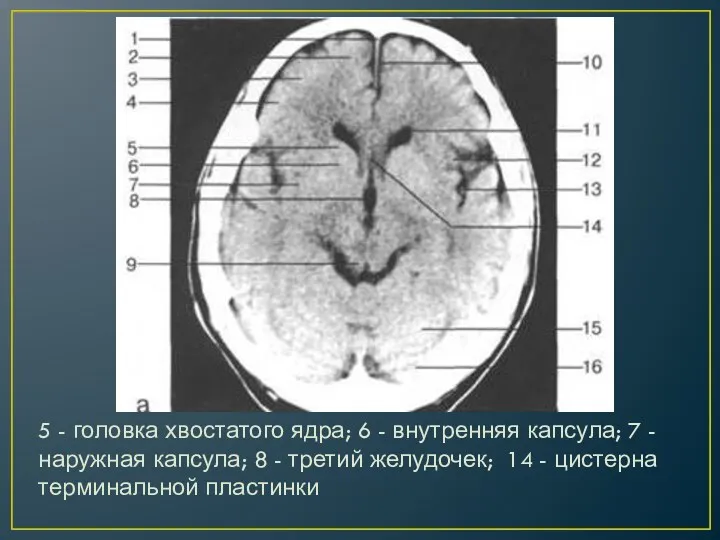 5 - головка хвостатого ядра; 6 - внутренняя капсула; 7