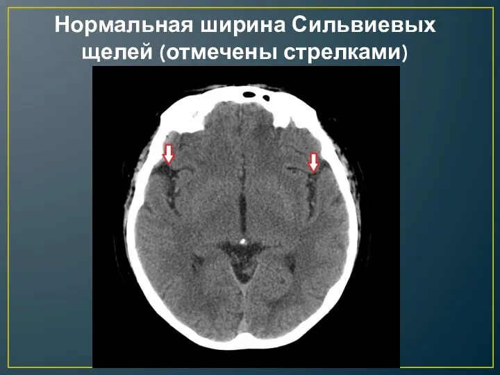 Нормальная ширина Сильвиевых щелей (отмечены стрелками)