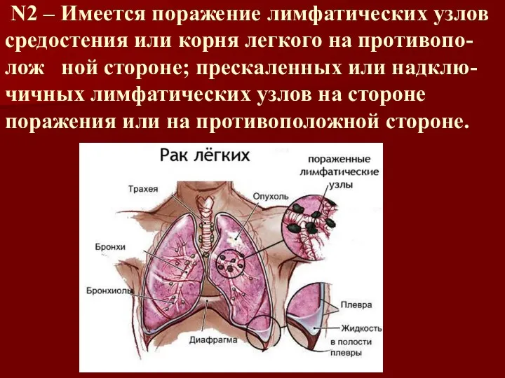 N2 – Имеется поражение лимфатических узлов средостения или корня легкого