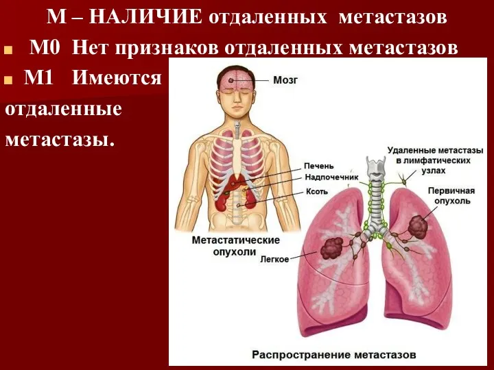 М – НАЛИЧИЕ отдаленных метастазов М0 Нет признаков отдаленных метастазов М1 Имеются отдаленные метастазы.