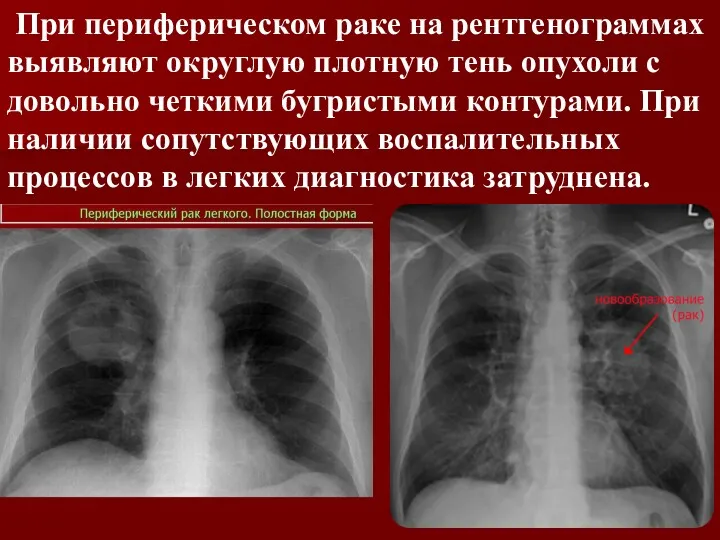 При периферическом раке на рентгенограммах выявляют округлую плотную тень опухоли