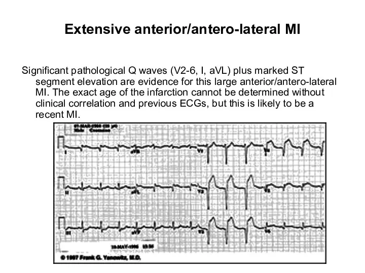 Extensive anterior/antero-lateral MI Significant pathological Q waves (V2-6, I, aVL) plus marked ST