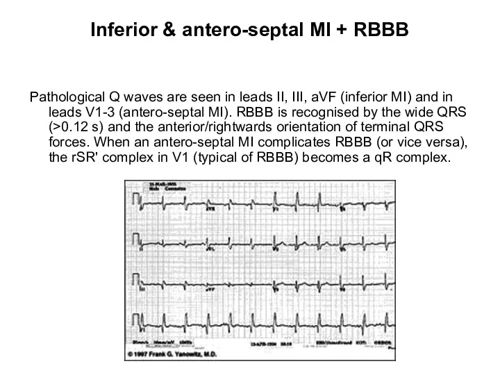 Inferior & antero-septal MI + RBBB Pathological Q waves are seen in leads