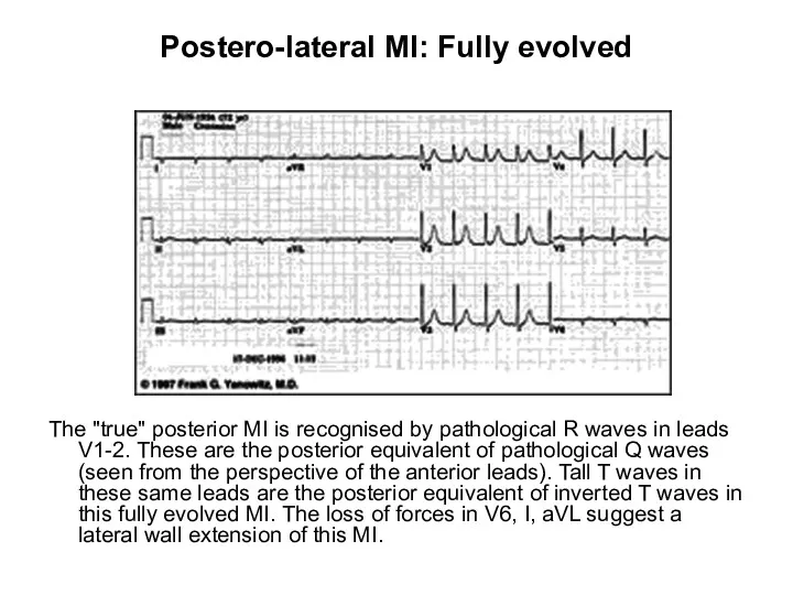 Postero-lateral MI: Fully evolved The "true" posterior MI is recognised by pathological R