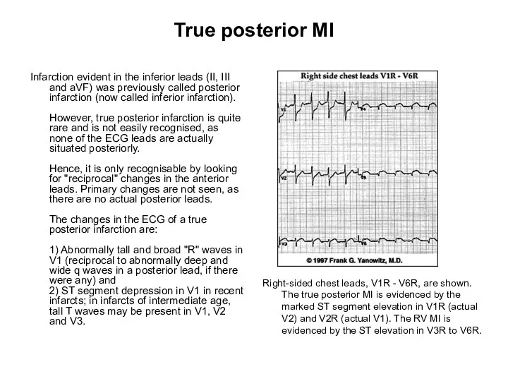 True posterior MI Infarction evident in the inferior leads (II, III and aVF)