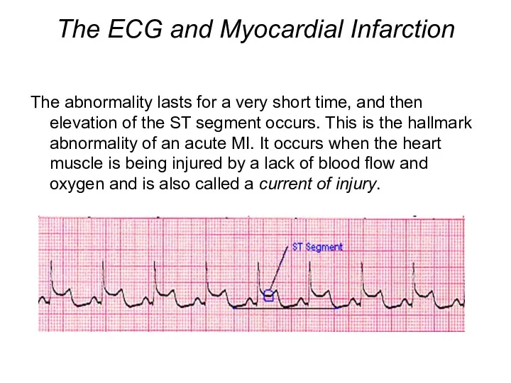 The ECG and Myocardial Infarction The abnormality lasts for a very short time,