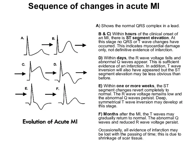 Sequence of changes in acute MI A) Shows the normal QRS complex in