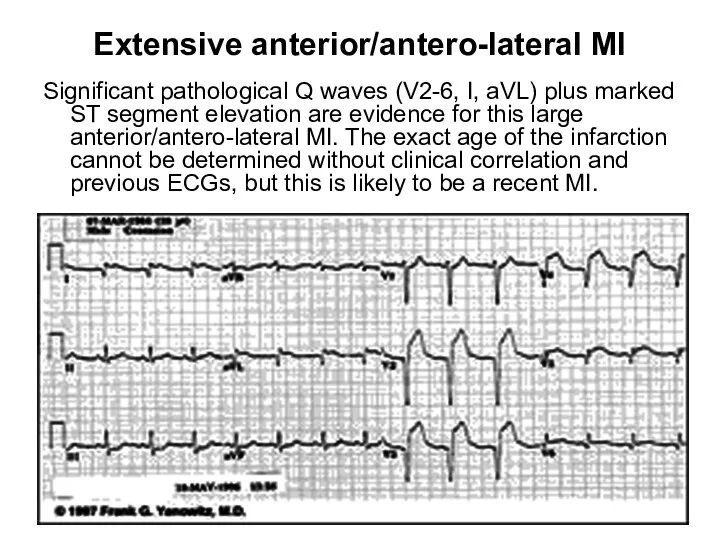Extensive anterior/antero-lateral MI Significant pathological Q waves (V2-6, I, aVL) plus marked ST
