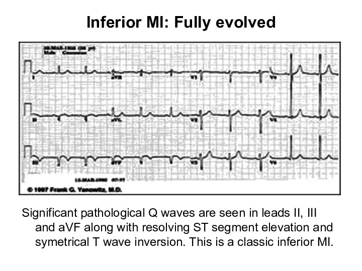 Inferior MI: Fully evolved Significant pathological Q waves are seen in leads II,