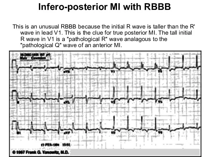 Infero-posterior MI with RBBB This is an unusual RBBB because the initial R