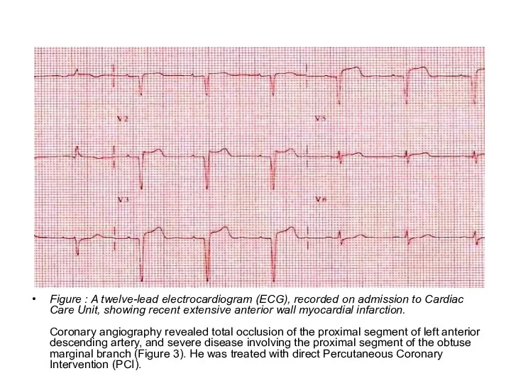 extensive anterior wall myocardial infarction. Figure : A twelve-lead electrocardiogram (ECG), recorded on