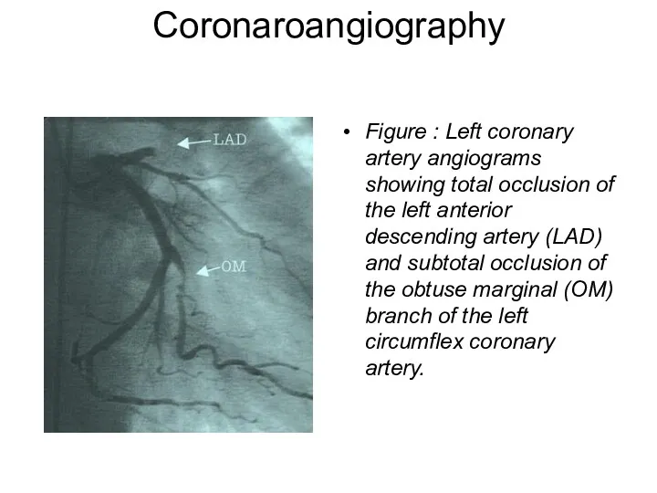 Coronaroangiography Figure : Left coronary artery angiograms showing total occlusion of the left