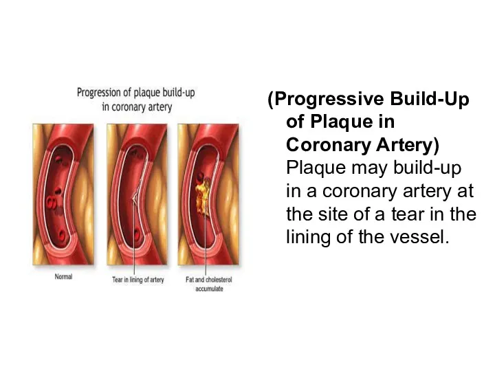 (Progressive Build-Up of Plaque in Coronary Artery) Plaque may build-up in a coronary