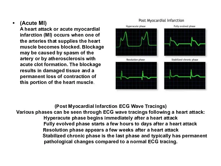 (Post Myocardial Infarction ECG Wave Tracings) Various phases can be seen through ECG
