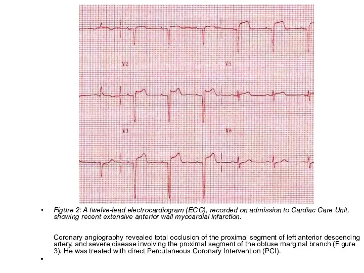 Figure 2: A twelve-lead electrocardiogram (ECG), recorded on admission to Cardiac Care Unit,