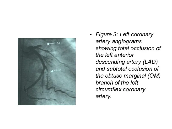 Figure 3: Left coronary artery angiograms showing total occlusion of the left anterior